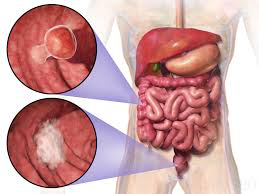 Colorectal cancer:कोलन कैंसर के लक्षणों का पता कैसे लगाएं?