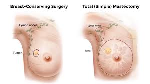 Breast cancer symptoms/स्तन कैंसर - लक्षण, कारण और उपचार