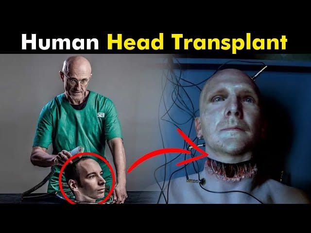 head transplant surgery:अब सिर को भी बदला जा सकता हैं?सिर के प्रत्यारोपण का पहला प्रयोग यशस्वी!