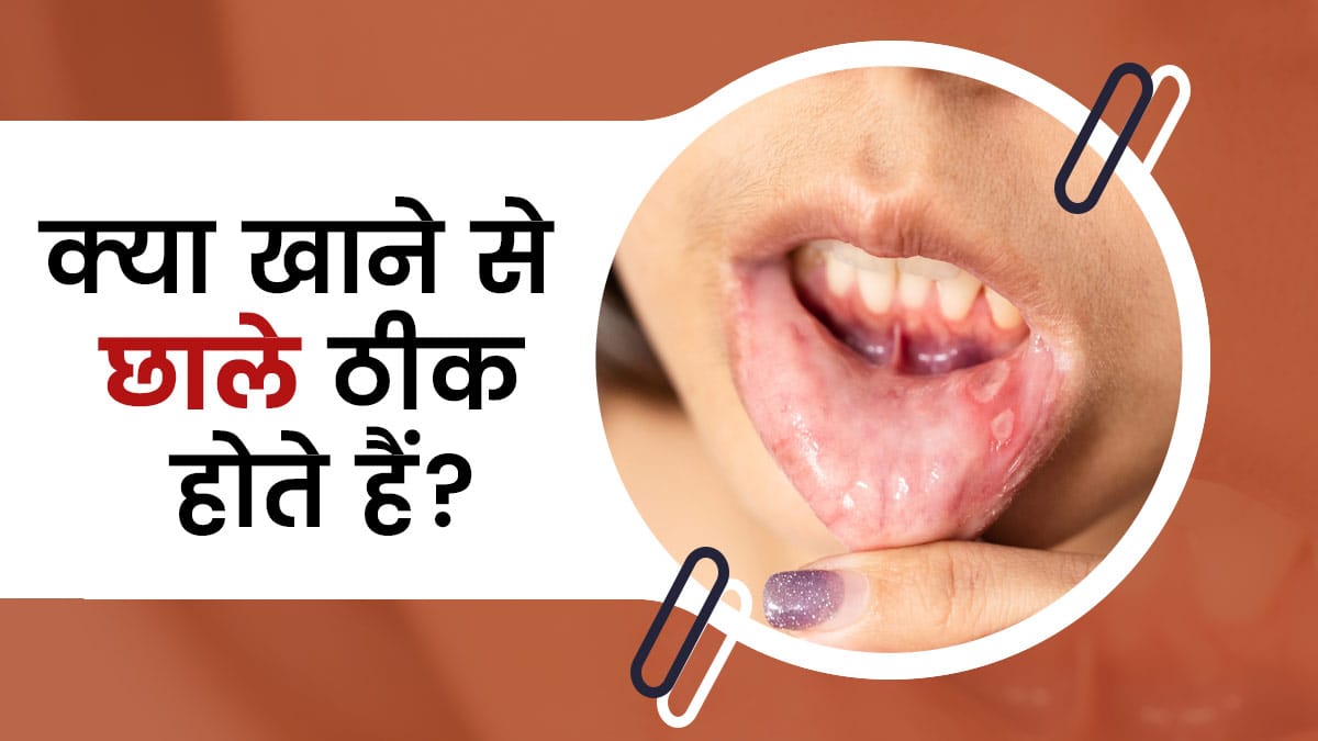 Mouth ulcer: मुंह के छाले देते हैं कई गंभीर बीमारियों के आने का संकेत