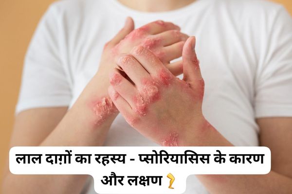 खुजली का राज - प्सोरियासिस क्या है?