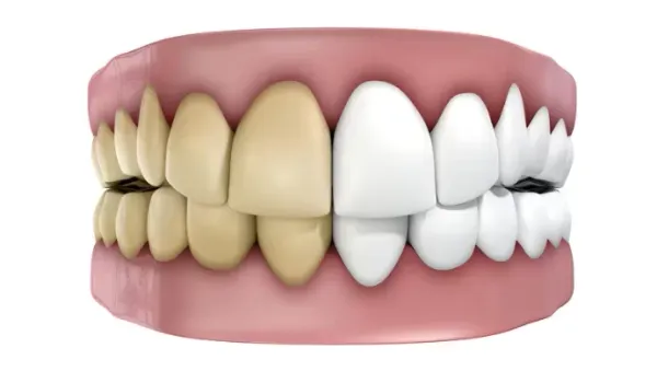 पीले दांतों को कैसे चमकाएं/yellow teeth remedies in hindi
